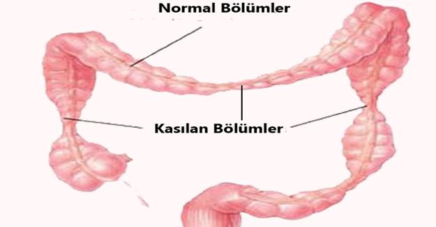 Beş kişiden biri bu hastalığa yakalanıyor