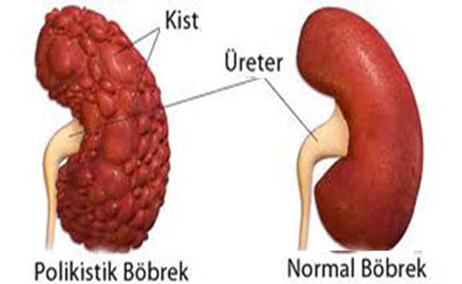 Polikistik böbrek hastalığında yeni umut